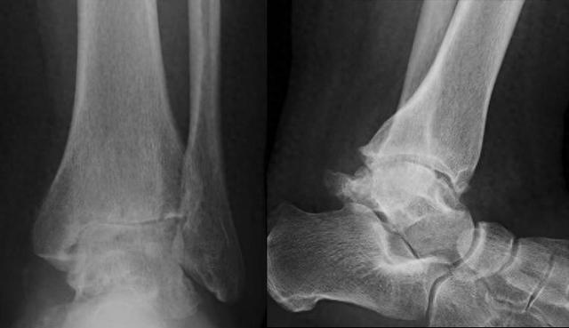 用脚做优化（量脚定制3D打印人工踝关节置换术为患者重塑步履新生）