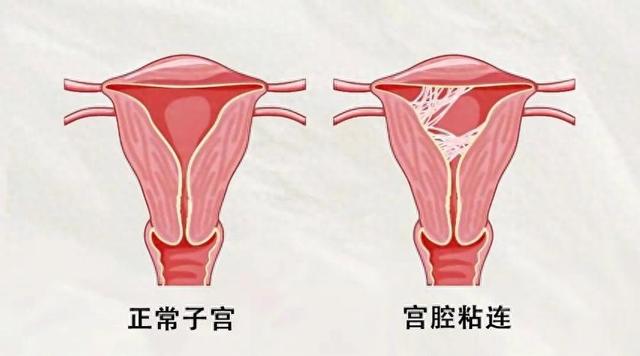 宫颈粘连的主要症状是什么（2535岁女性反复人流）