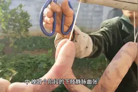 得了下肢静脉曲张怎么办？科学服用5种药物，改善下肢循环图片