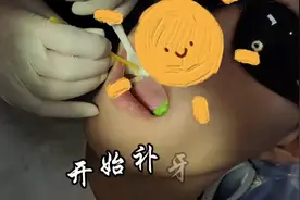 口腔工作：根管治疗后做牙冠的选择图片