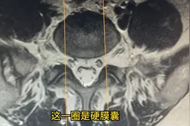 腰椎间盘突出从腰痛到大小便失禁只需要三步，3分钟讲清楚过程图片