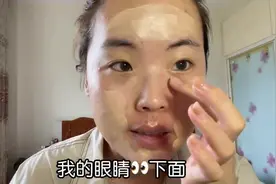 光子嫩肤五天后眼下的黄斑消失了！ #痘印图片