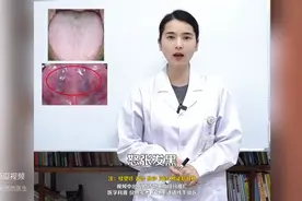 舌底青筋凸起，吃再多血府逐瘀丸也无效！图片