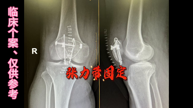 髌骨骨折的康复锻炼方法