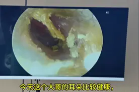 黄金右耳，解压视频又来啦！#专业采耳图片