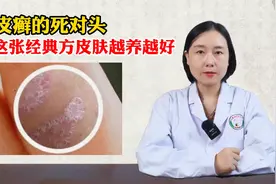 牛皮癣的“死对头”，用好这张经典方，皮肤越养越好图片