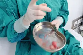 腺肌症病灶不多，却长的位置很深，腺肌瘤长到了肠管上图片