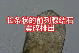 长条形前列腺结石被冲击波震碎排出图片