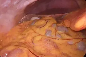 身高160厘米，重120斤，来看内脏脂肪多不多，有没有脂肪肝图片