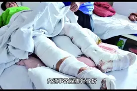 交通事故，胫腓骨骨折能赔偿多少钱？图片