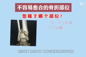 不容易愈合的骨折部位 您属于哪个部位图片