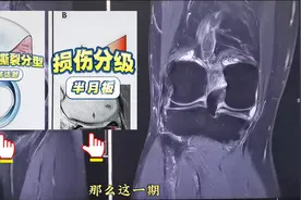 半月板损伤分级与撕裂分型的临床意义 #医学生图片