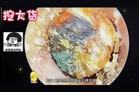 王阿姨的耳朵里长出了一块巨型大货#采耳图片