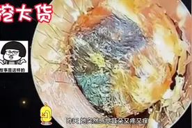 王阿姨的耳朵里长出了一块巨型大货#采耳图片