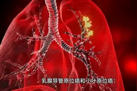 是否乳腺癌都需要化疗？ #乳腺癌化疗图片