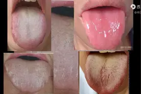 观舌象，舌质淡红、齿痕严重，4种舌象信号，要警惕及注意事项图片