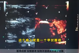 甲状腺癌是手术切除后，多发淋巴结转移（一） #甲状腺癌图片
