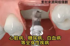 这几类人竟然不适合做种植牙？看看你有这些情况吗？图片