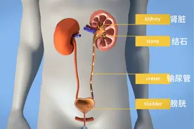 体外冲击波碎石过程图片