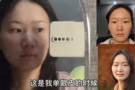 记录双眼皮蜕变过程 终于摆脱容貌焦虑，摆脱大小眼和超级肿眼泡图片