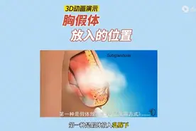 3D动画演示胸假体植入的位置图片