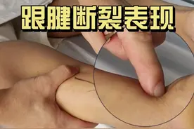 跟腱断裂的表现 #硬核健康科普行动  #跟腱断裂 #跟腱断裂是什么感觉 #骨科医生 #查房日常视频封面