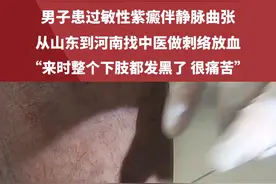 男子患过敏性紫癜伴静脉曲张，从山东到河南找中医做刺络放血，“来时整个下肢都发黑了，很痛苦”#中医  #中医针灸  #刺络放血 #静脉曲张视频封面