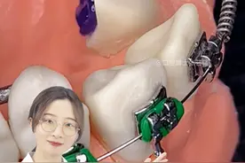 牙齿不在正常的位置上，容易造成诸多口腔问题，牙齿矫正就可以帮助牙齿回归原位！#牙齿矫正 #正畸矫正 #口腔健康 #牙医日常