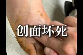 关关难过，关关过！夜夜难熬，夜夜熬！ 这个病人从外伤急诊清创缝合，到创面坏死，到骨折固定，再到创面封闭负压治疗，再到拆除负压，多次换药，最终终于修成正果，创面长好了，钢针也拔掉了！意外受伤同时也伴随着各种意外，人生，难啊，可再难也要挺过去吧，医生永远是最希望病人好起来的，同样，有问题共同面对，强大的凝聚力必定战胜病魔#骨科蒋江云医生 #远离伤病 #医生日常 #手术室你不知道的事 #医学科普视频封面