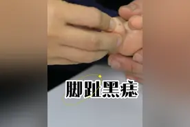 孩子脚部黑痣建议早切除，警惕黑色素瘤！#脚趾黑痣 #脚底黑痣 #脚底黑痣黑色素瘤要及时切除 #硬核健康科普行动  #刘新海医生视频封面