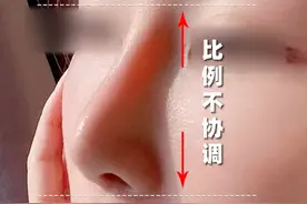 “一眼假”鼻子如何修复L型硅胶发红 过长 歪斜！#牛永敢 #鼻修复 #隆鼻 #L型硅胶隆鼻取出来会恢复原样吗 #隆鼻假体显型修复视频封面
