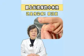 脚趾、脚底脱皮，长小水泡，很痒，这是#脚气 ，不及时处理会传染！#联苯苄唑喷雾 #水泡型脚气 #硬核健康科普行动  #脚气用什么药最管用