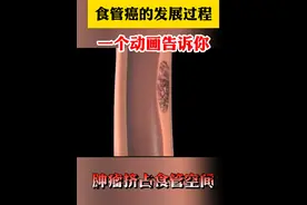 食管癌的发展过程，一个动画告诉你！#食管癌 #健康科普