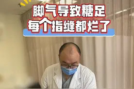 脚气导致足部溃烂不愈合，每个趾缝都烂了！ 糖友足部的健康很重要，一些细微的小问题都可能引发严重后果，#糖尿病足 及时就医，找对医生，避免情况严重。#糖尿病足早期表现视频封面