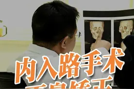 歪鼻矫正不切鼻小柱，内镜手木微创方案。 #歪鼻矫正 可以鼻小柱不切口，内镜技术内入路手木，为患者提供了微创新方案。#歪鼻 #八大处整形医院 #鼻骨骨折视频封面