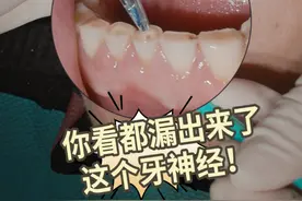 长期吃硬东西，牙齿被磨成这样了 一定要改变饮食习惯啊！#口腔科普 #爱护牙齿 #硬核健康科普行动视频封面