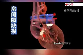 4种常见先天性心脏病 你知道几种？#抖出健康知识宝藏  #一种看似偷懒其实健康的行为 #先心病 #室缺 #房缺 视频封面