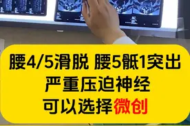 腰45滑脱 腰5骶1突出 严重压迫神经可以选择微创 #滑脱 #腰间盘突出  #北京大学人民医院视频封面