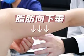 手臂吸脂具体都能吸哪里？一条视频讲清楚！ #手臂吸脂 #瘦手臂 #拜拜肉视频封面