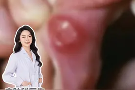 嘴巴里面出现不痛不痒的“溃疡”？这是梅毒！不是口腔溃疡！ #梅毒 #梅毒是什么 #梅毒有什么症状 #硬下疳 #硬核健康科普行动 @抖音短视频视频封面