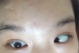 很多人问我，成人#斜视 能矫正么，答案肯定是可以的！#北大眼科朱大夫 #斜视手术 @抖音短视频视频封面