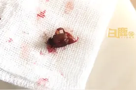 男子半夜耳朵痛醒取出指甲大虫子。#可怕 #虫子 视频封面