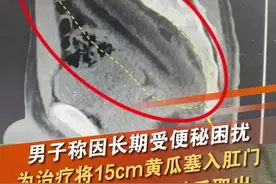 江苏扬州的一名男子因经常熬夜，爱吃炸鸡年糕等食物，长期受便秘困扰。3月27日，他试图将黄瓜塞入肛门刺激排便，不料滑入直肠无法取出，就医后，医生将其麻醉，20分钟完整取出了长达15cm的黄瓜。（来源： 扬子晚报）#黄瓜 #便秘 #偏方 #直肠 #促进排便 @抖音短视频 @DOU+小助手视频封面