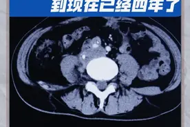 平滑肌肉瘤复发多次，在积极抗争的路上，现在四年了，继续加油 #腹膜后肿瘤 #腹膜后脂肪肉瘤 #腹膜后纤维化 #腹膜后平滑肌肉瘤 #硬核健康科普行动视频封面