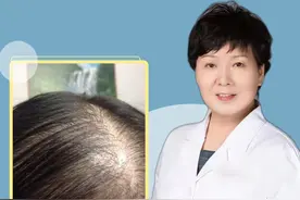 正确使用米诺地尔 警惕变成“小毛人” 