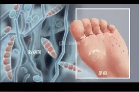 #脚气 #脚臭 #抗真菌药膏 #医学科普  