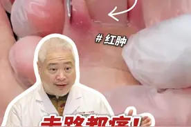 指甲红肿❗甲沟炎❗医生简单2步教你搞定✅ #甲沟炎 #剪指甲 #硬核健康科普行动  #入冬换季不患疾 #健康生活重养自己一遍视频封面