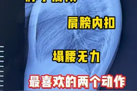 脖子前倾 肩膀内扣 塌腰无力 最喜欢的两个动作 #脖子前倾 #肩膀内扣 #塌腰无力 #不良体态纠正 #抖出健康知识宝藏视频封面