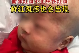 面部红斑不止中性红斑，鲜红斑痣也会出现。#鲜红斑痣 #鲜红斑痣宝宝 #红胎记 #胎记 #胎记宝宝视频封面