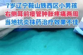 耳前瘘管肿胀的非常厉害，马上要破溃了#耳前瘘管 #抖出健康知识宝藏  #武汉陈金辉视频封面